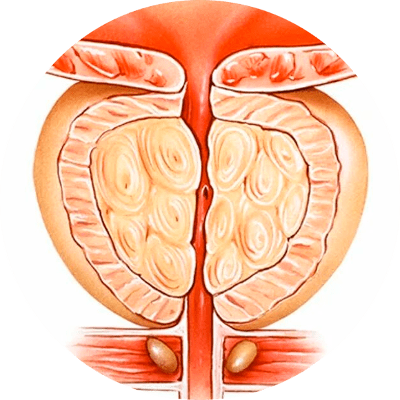 Consecuencias da prostatite non tratada