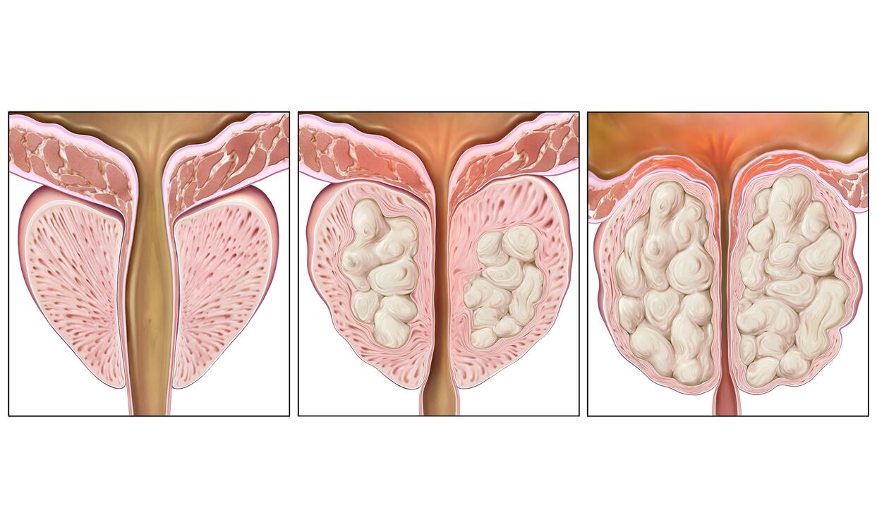 fases do cancro de próstata