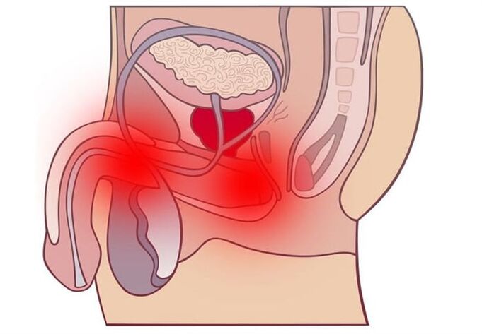 métodos de tratamento da prostatite